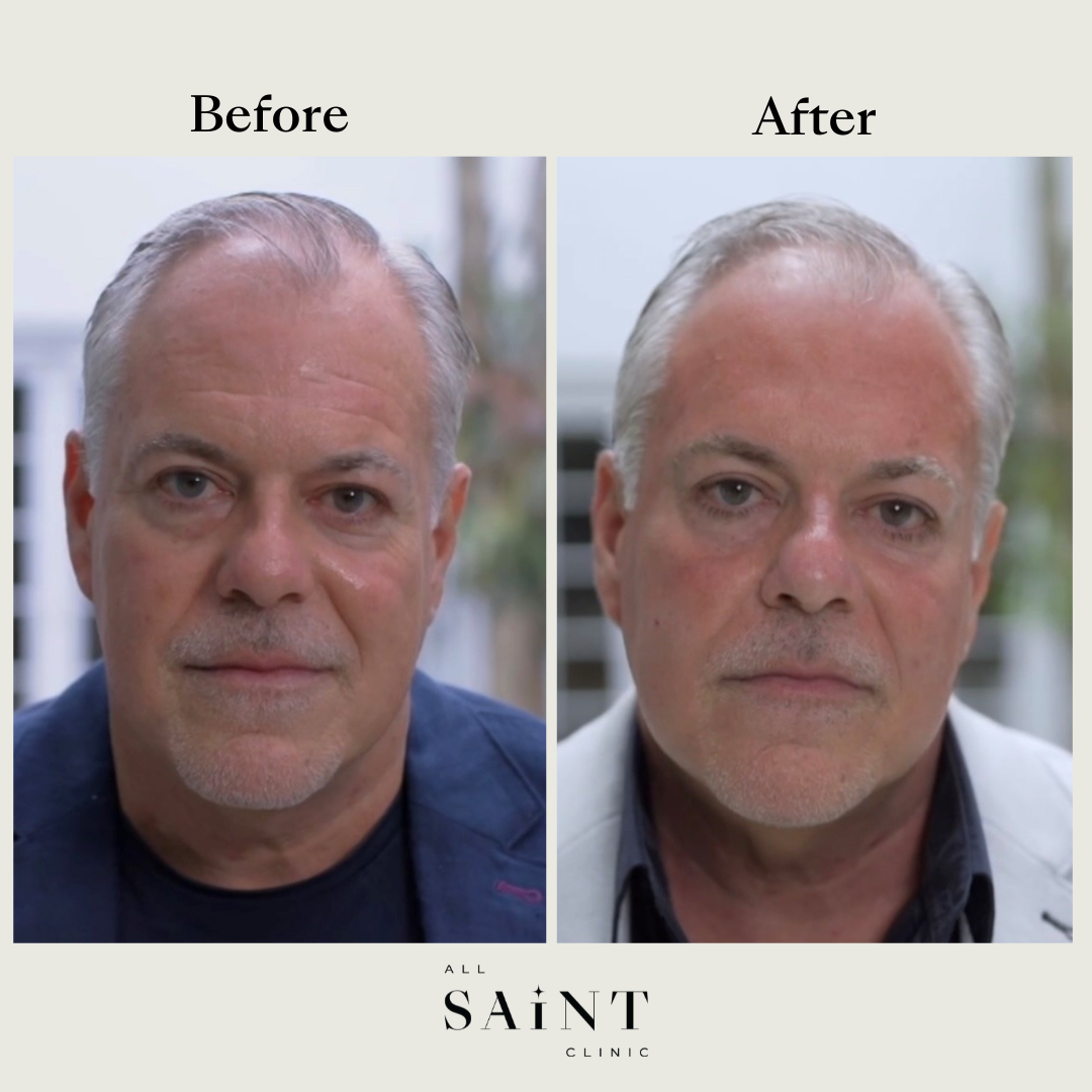 Botox Sydney - Men's Before and After