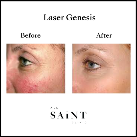 Laser Genesis Sydney - Rejuvenating Facial Before and After