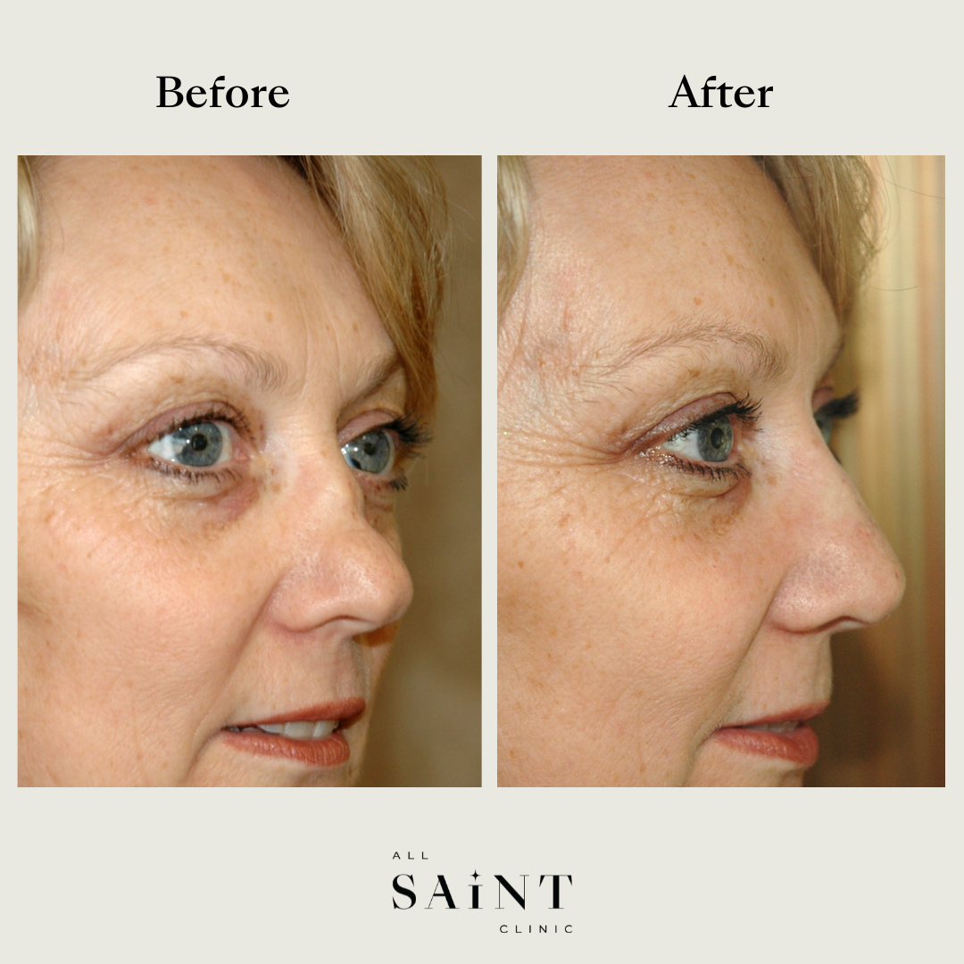 Non Surgical Nose Job Sydney - Before and After