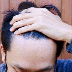 man suffering from spots close to his hairline due to cosmetic products