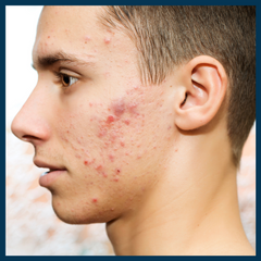 Dr Sam Robson, LUSTRE ClearSkin, blog, seasonal variations in acne