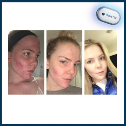 Freyja-before-and-after-her-LUSTRE-ClearSkin-blue-light-acne-treatment