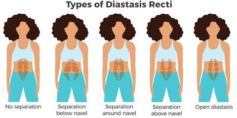 types of diastasis recti 