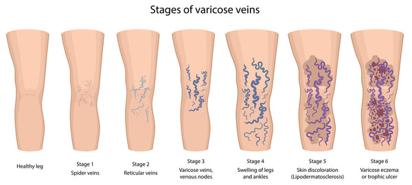 Stages of varicose veins