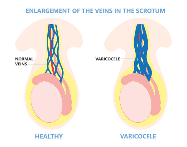 Varicocele - varicose vein by testicle