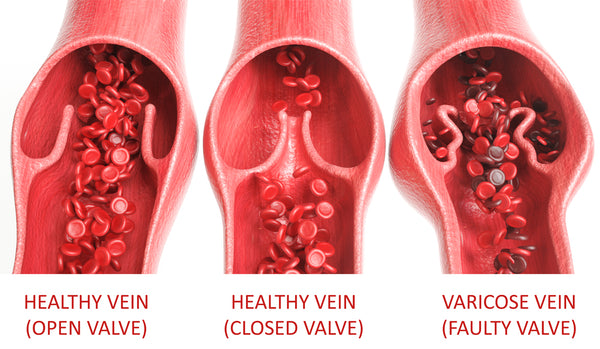 What causes varicose veins in men