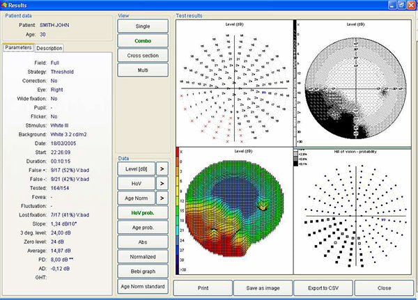 Automated Kinetic and Static Perimeter with Embedded PC with Mount with Monitor AP-300 frey - us ophthalmic