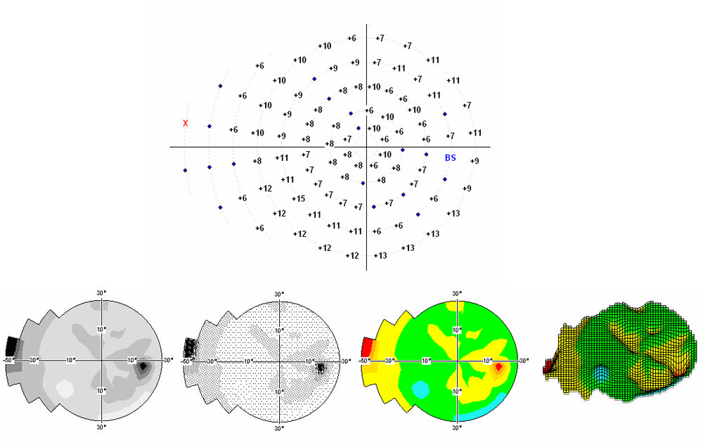 Automated Kinetic and Static Perimeter with Embedded PC with Mount with Monitor AP-300 frey - us ophthalmic