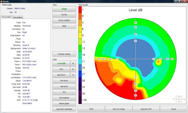 Automated Static Perimeter AP-50 frey - us ophthalmic