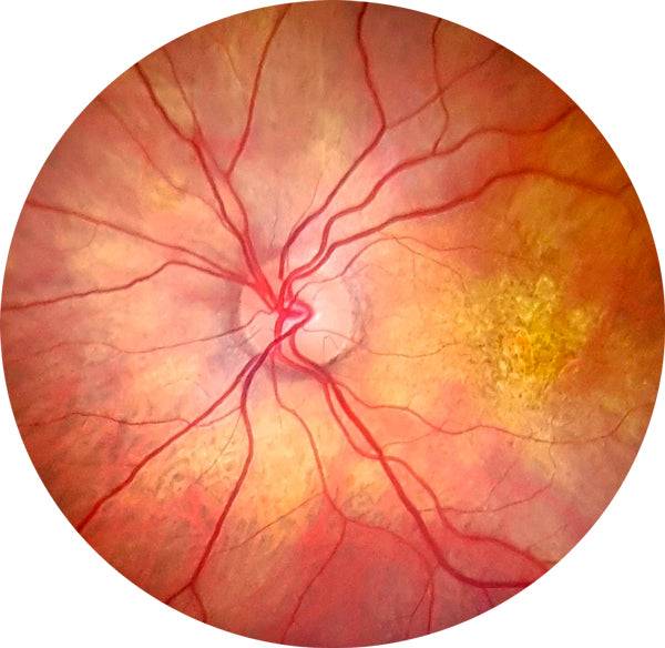 retinal camera eyer nm top phelcom - us ophthalmic