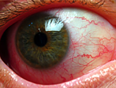 ez-horus anterior lens af ezer - us ophthalmic