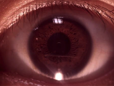 ez-horus anterior lens af ezer - us ophthalmic