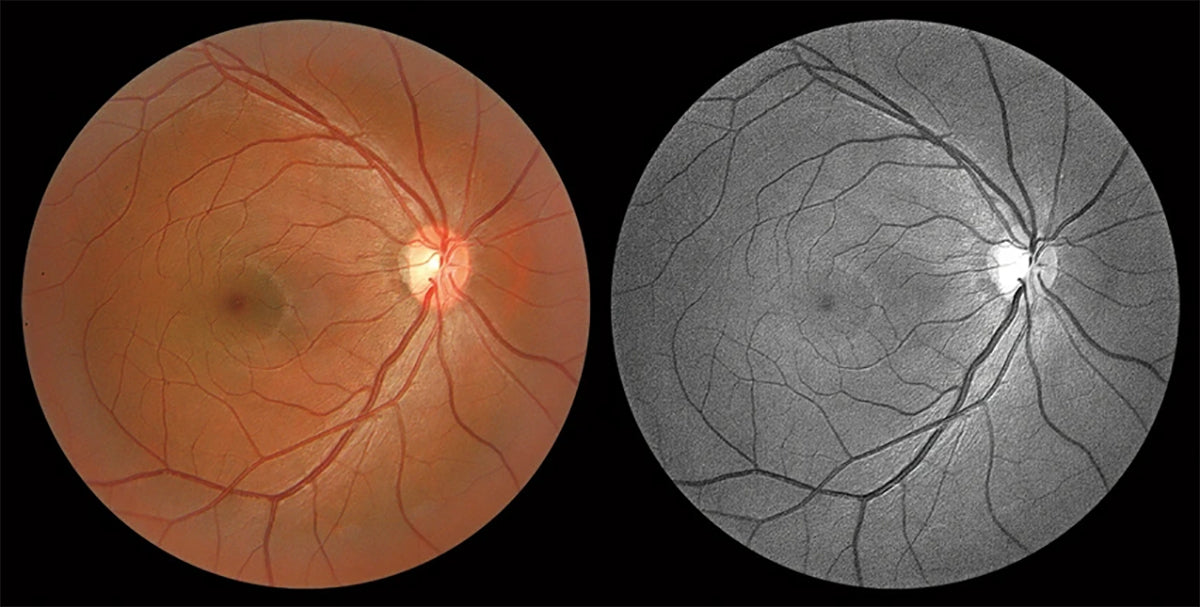 retinal camera hfc1 huvitz