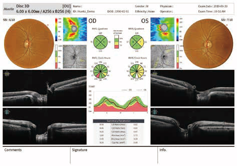 optical coherence tomography hoct-1 huvitz - us ophthalmic