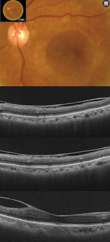 optical coherence tomography hoct-1 huvitz - us ophthalmic