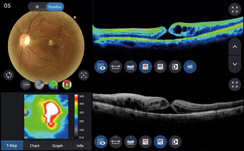 optical coherence tomography hoct-1 huvitz - us ophthalmic