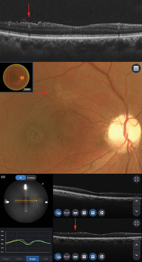 optical coherence tomography hoct-1 huvitz - us ophthalmic