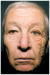 Face of an older man with significant aging and sun damage on the left side of his face from a career as a truck driver.