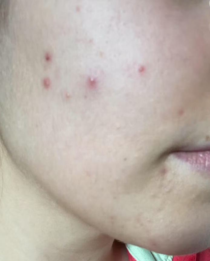 Close-up of a cheek with several small acne spots.