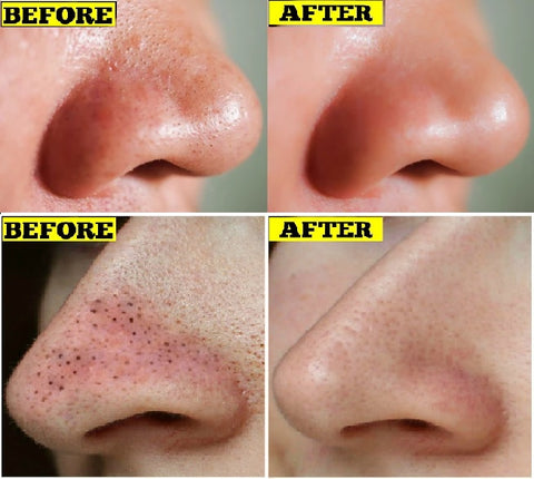 Before and after pictures of a woman's nose using a blackhead remover.