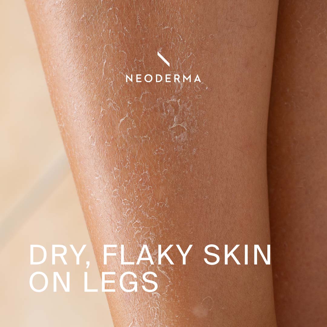 dry-flaky-skin-on-legs-neoderma