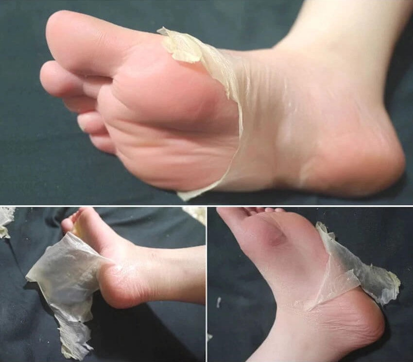 Foot Peel Mask Exfoliator Peel Off Calluses Dead Skin Callus Remover Foot  Mask