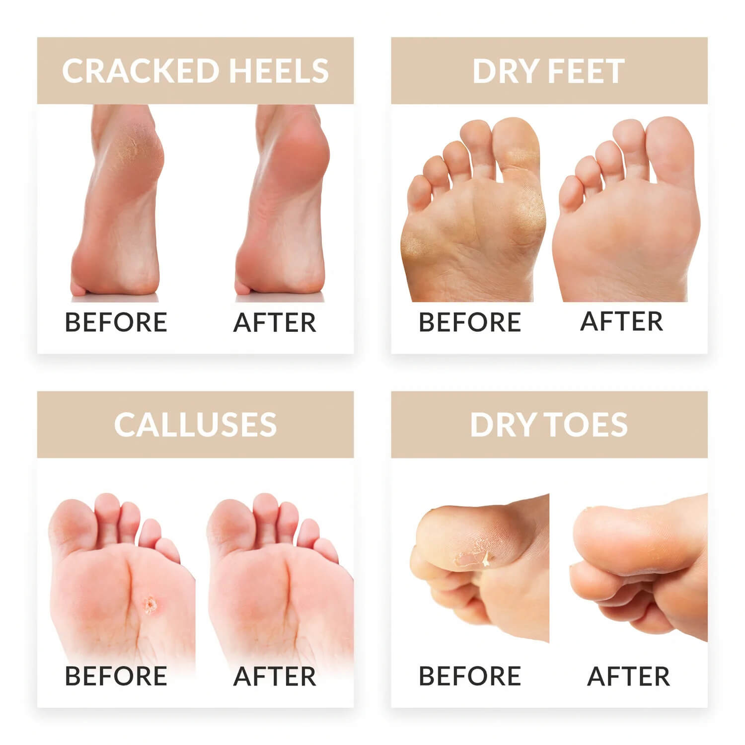 Foot Peel Mask, Exfoliator Peel Off Calluses Dead Skin Callus Remover Soft  Smooth Touch Feet Repair Rough Heel
