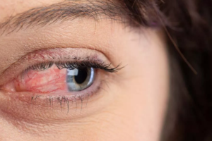 Ocular Rosacea