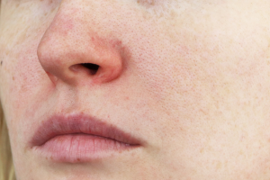 Phymatous Rosacea 