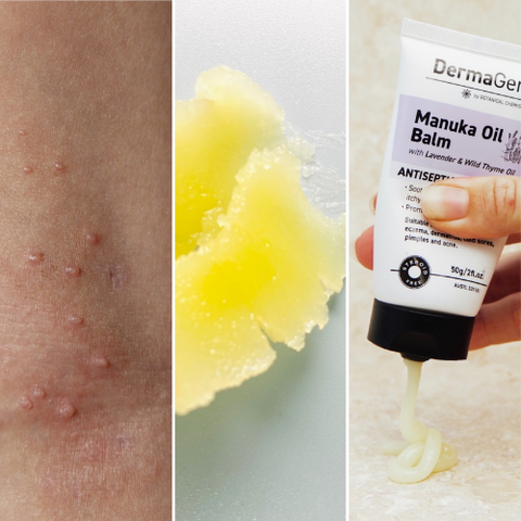 Why Dermagen's Manuka Oil Products Are Your Best Bet for Molluscum Contagiosum Relief