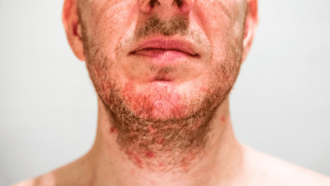 Atopic Dermatitis on the neck