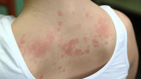 photo de dermatite atopique