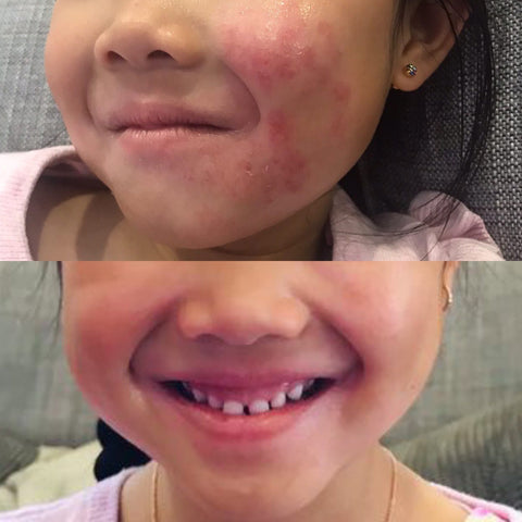 before 7 after baby eczema