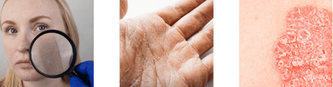 Prolonged Exposure to Water with Eczema