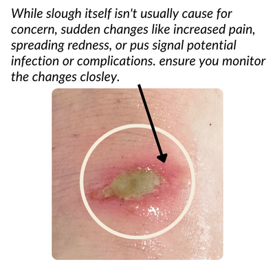 While slough itself isn't usually cause for concern, sudden changes like increased pain, spreading redness, or pus signal potential infection or complications. ensure you monitor the changes closley.