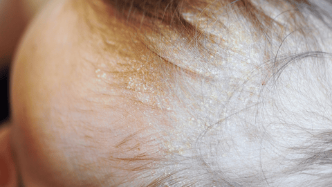 seborheic dermatitis picture scalp