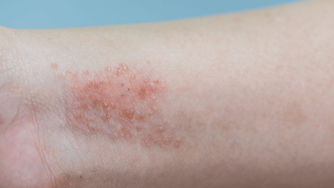 Photo de dermatite xérotique du poignet