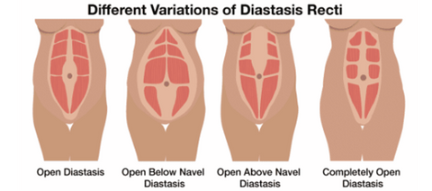 4 types of abdominal separation