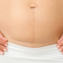 c-section scars