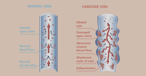 pregnancy varicose veins