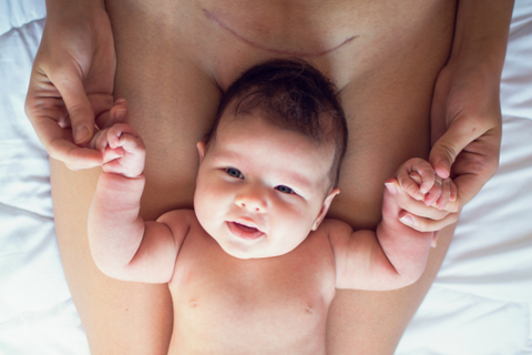 C-Section Recovery and Aftercare