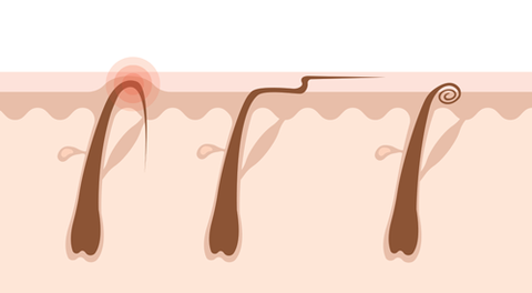 illustration of ingrown hairs