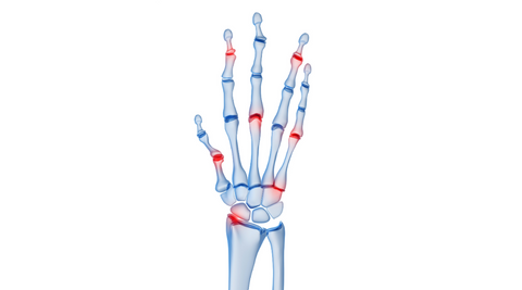 Arthritis