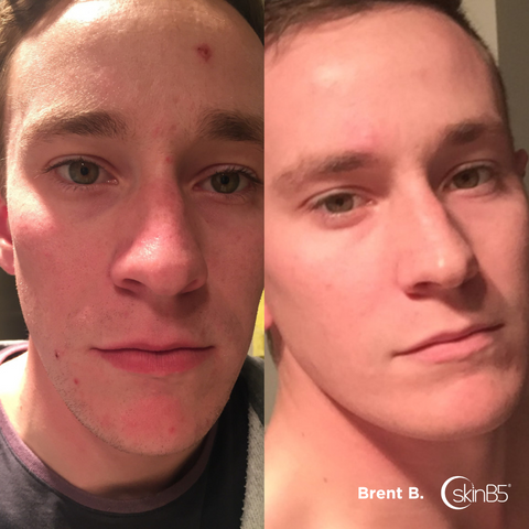 Learn how Brent Banks overcome persistent acne with skinB5™