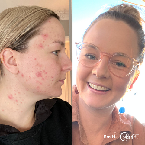SKINB5™ HELPED EM HANNAN COMPLETELY CLEARED UP HER ACNE IN 2 WEEKS