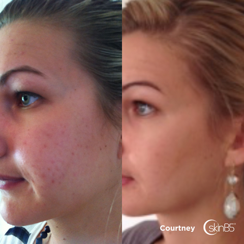 How Courtney overcome oily skin and acne with skinB5™