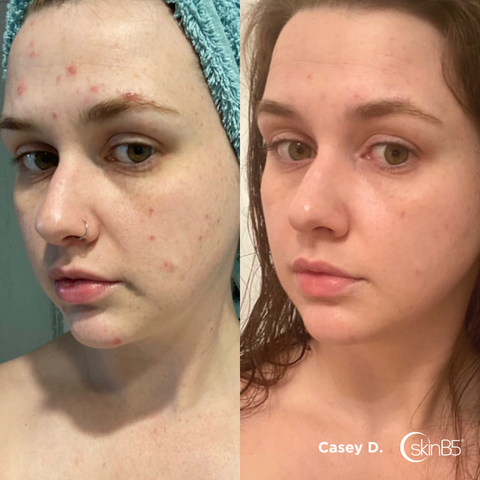 How Casey Davis completely cleared up her acne within 2 weeks