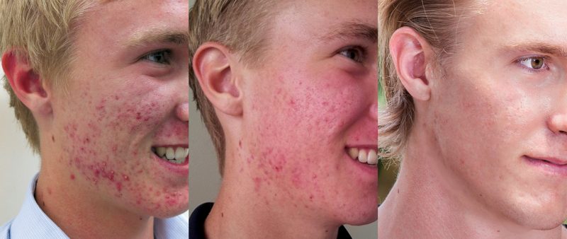 Australian actor Luis Barnett fixed severe teenage acne using skinB5 proven acne control system