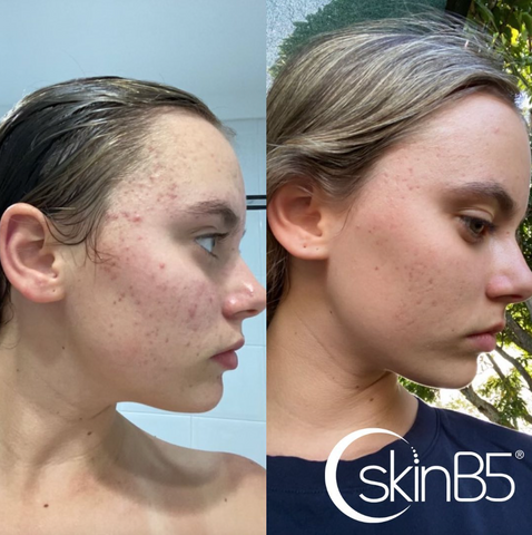 SkinB5 – the simple skin wellness system treating acne quickly, effectively, and naturally.