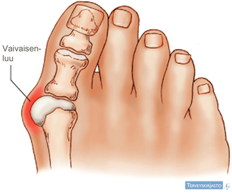 Hallux valgus ehk suurel varbal "nukk"